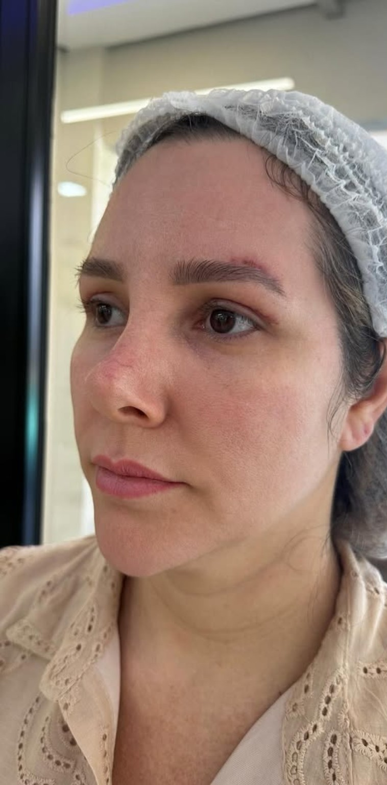 Dra. Aline Francini especialista em harmonização facial em Três Lagoas MS