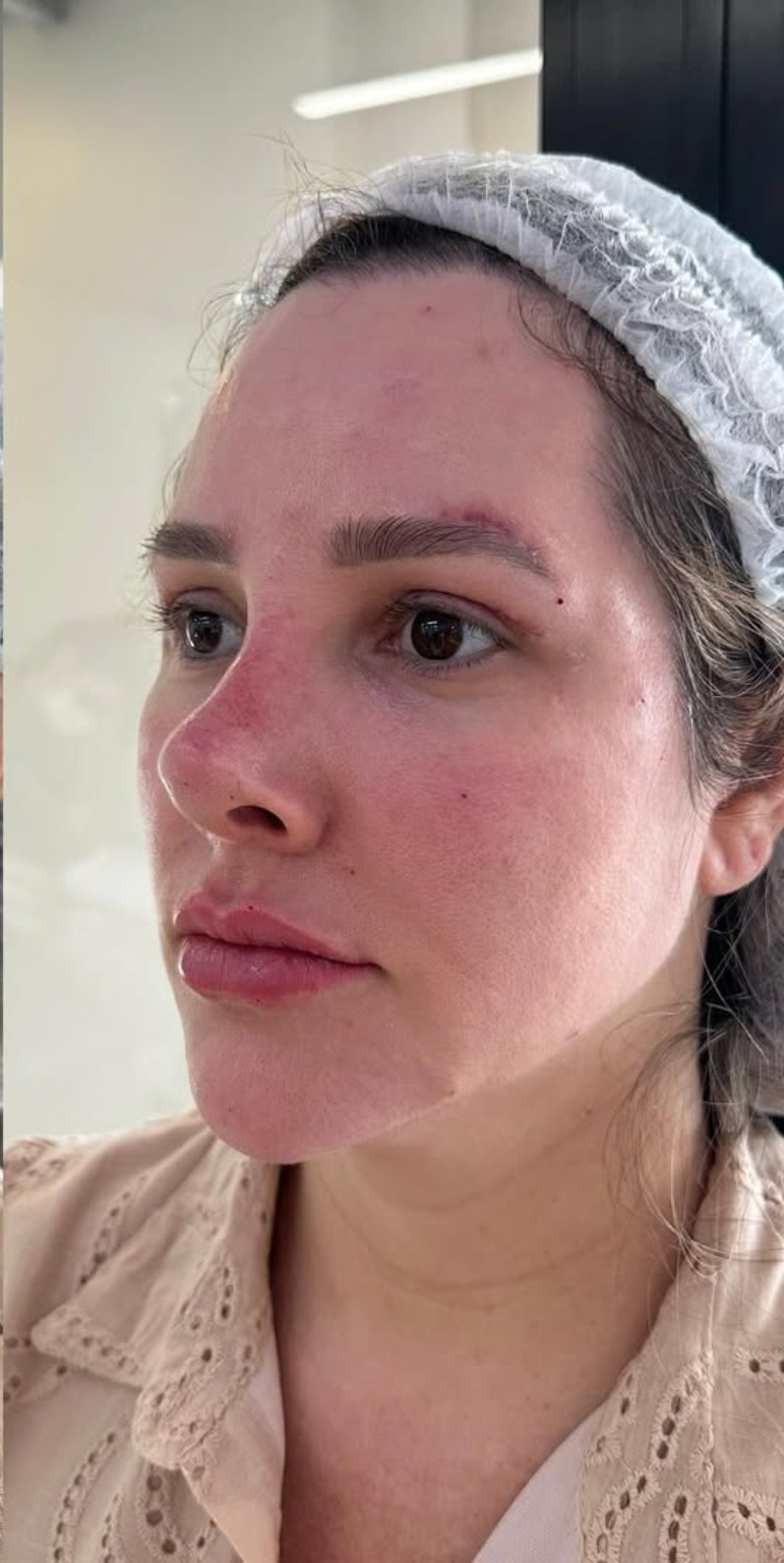 Dra. Aline Francini especialista em harmonização facial em Três Lagoas MS