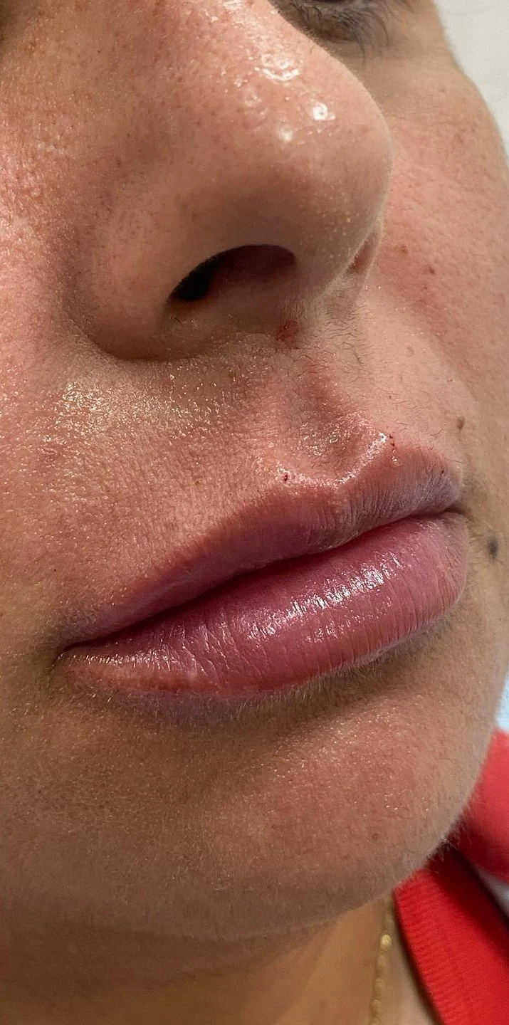 Dra. Aline Francini especialista em harmonização facial em Três Lagoas MS